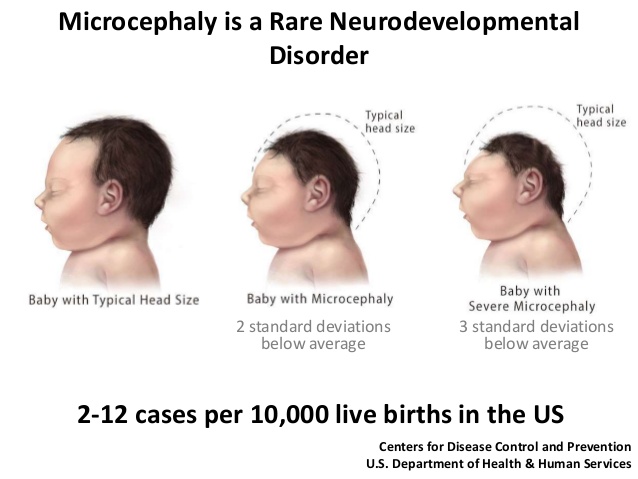 zika-virus-and-microcephaly-4-638